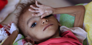 400 000 enfants yéménites risquent de mourir de malnutrition en 2021