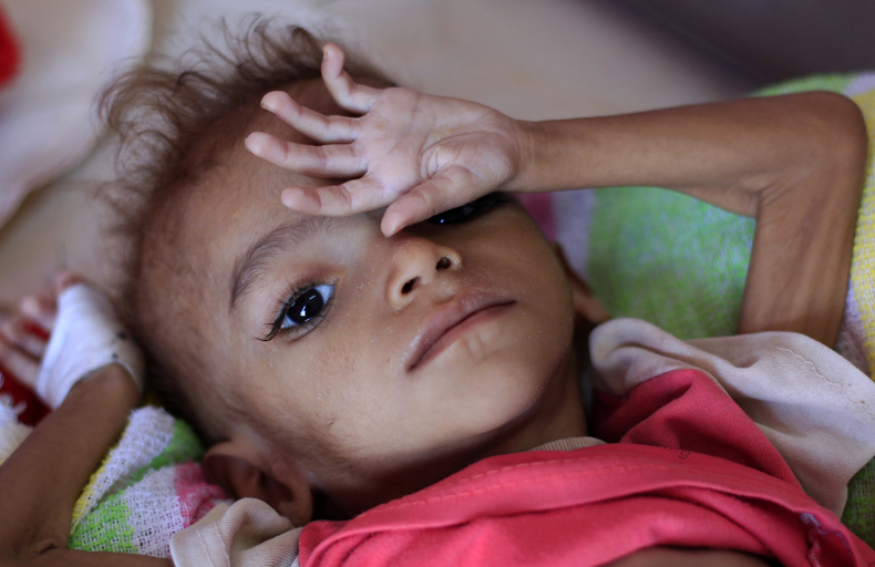 Enfant souffrant de malnutrition au Yémen