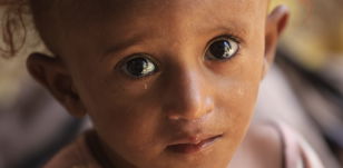 La Malnutrition au Yémen et en Somalie
