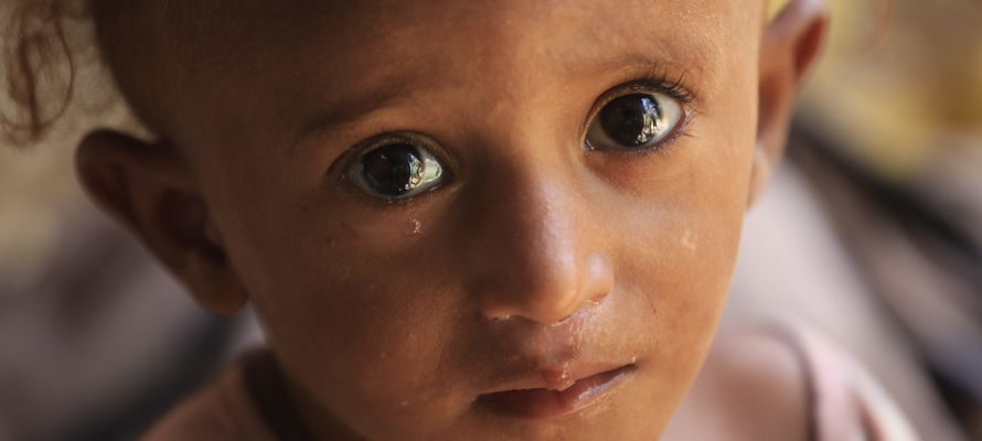 La Malnutrition au Yémen et en Somalie